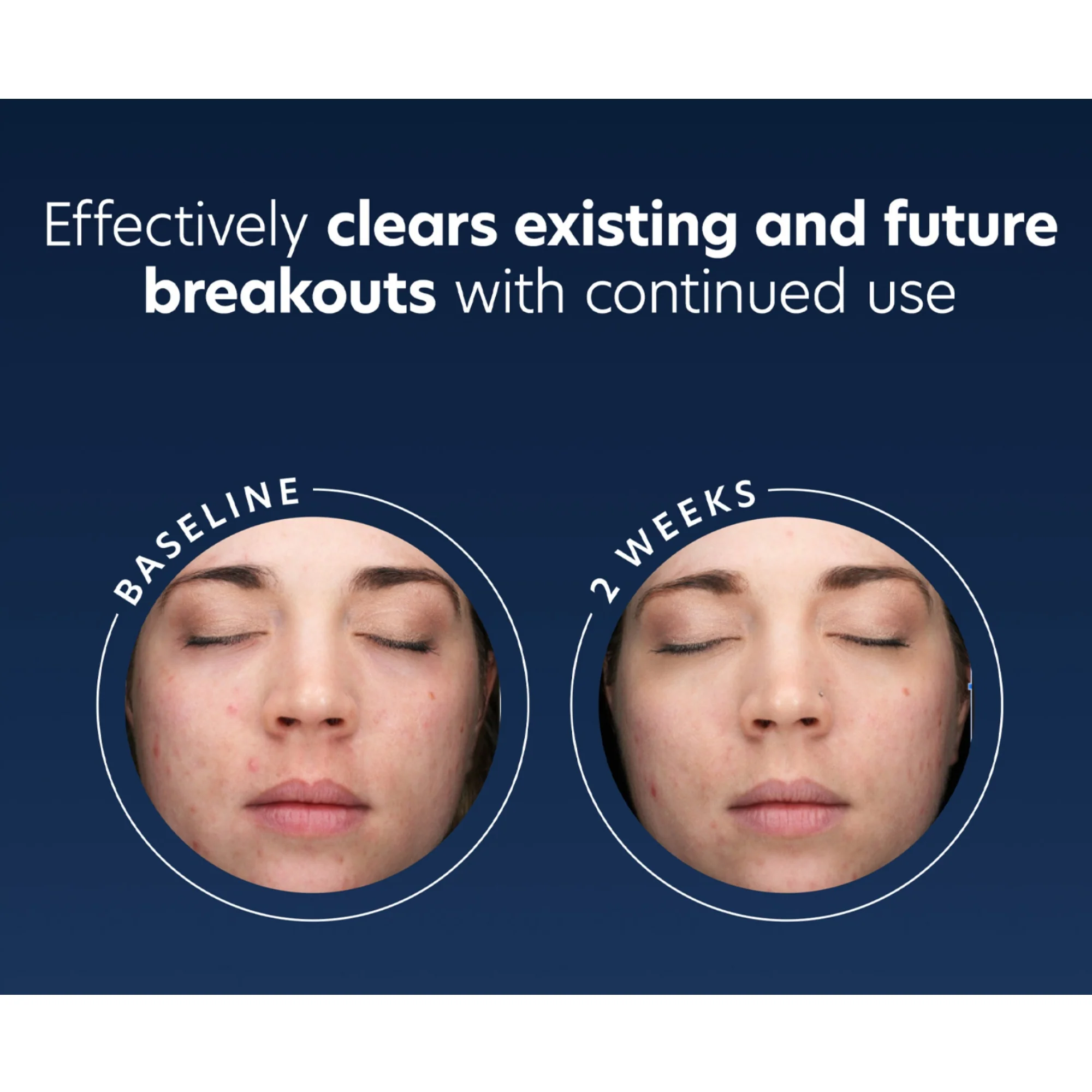 Acne Gel - Image 9