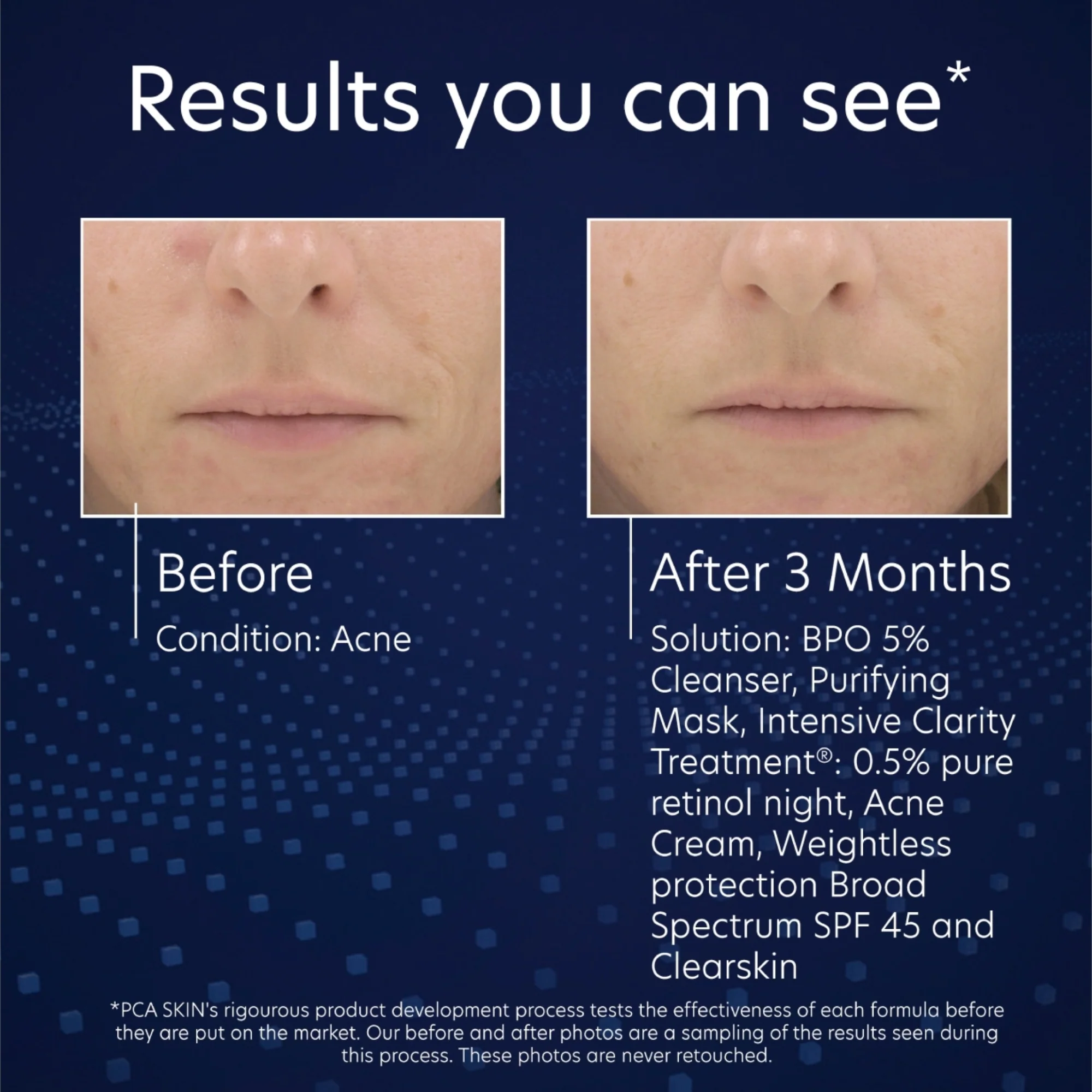 BPO 5% Cleanser - Image 7