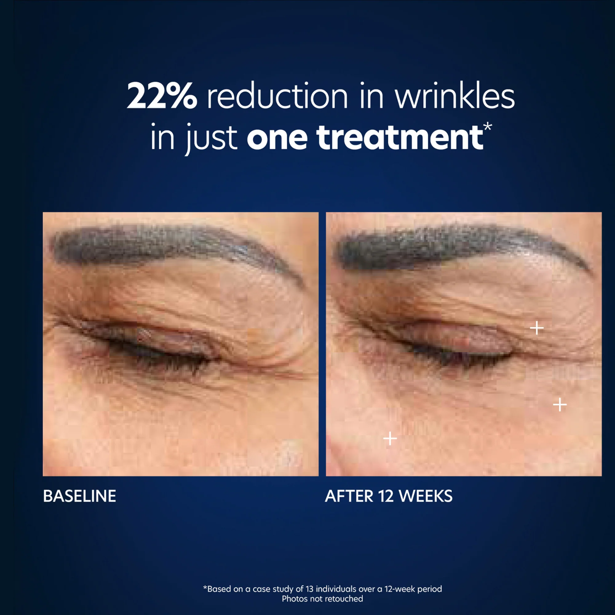 Hyaluronic Acid Microneedle Eye Patches - Image 10