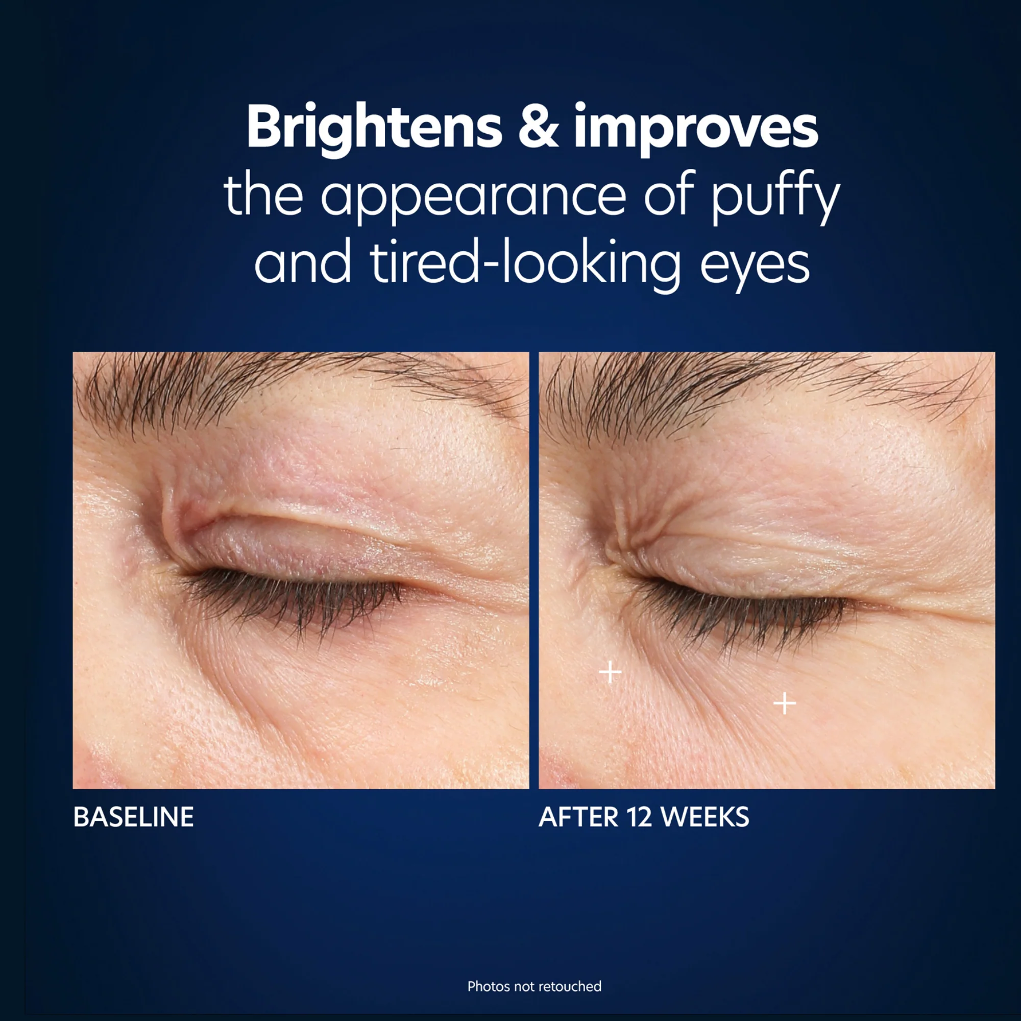 Hyaluronic Acid Microneedle Eye Patches - Image 8